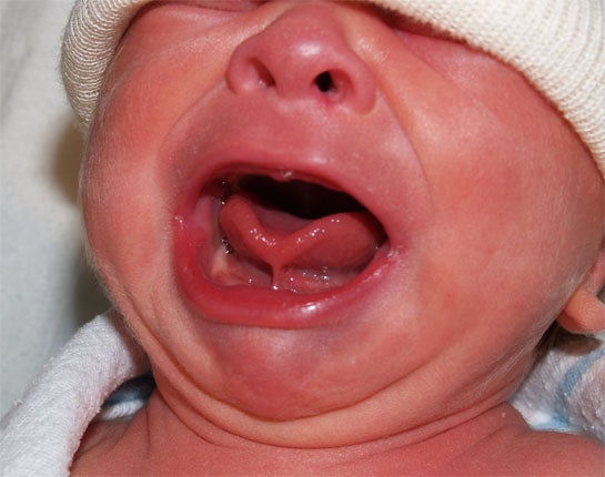Tongue ankyloglossia Janelle Aby, MD Stanford University Medical Center.jpg